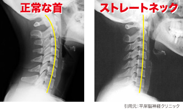 ストレートネックレントゲン画像