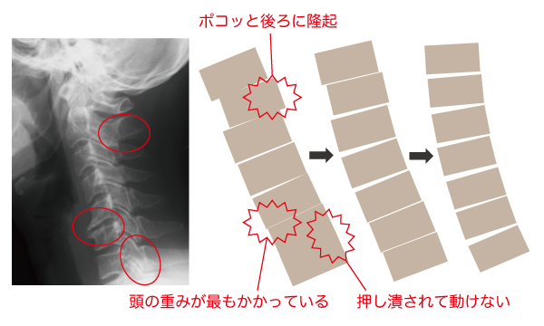 頚椎ゆがみ